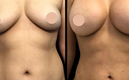 Guide to Breast Augmentation Surgery in Dubai 2025