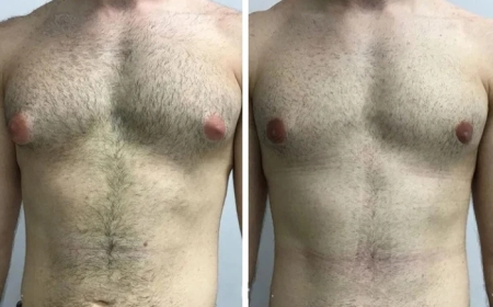 Virtual Consultation Options with the Best Gynecomastia Surgeon in Dubai