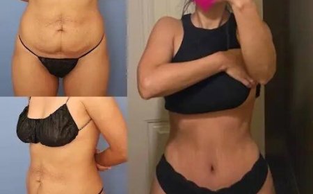 The Best Tummy Tuck Surgeon in Dubai: Helping You Achieve Your Goals