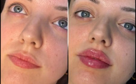 What Makes Fillers Safe with the Best Plastic Surgeon in Dubai?