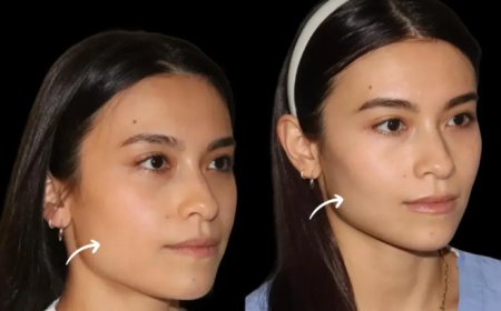 What to Expect from Your First Sculptra Fillers Treatment in Dubai