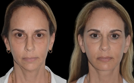 Top Benefits of Chin Fillers Treatment in Dubai for Facial Balance