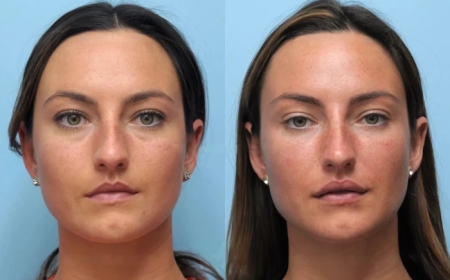 Exploring Thread Lift Treatment in Dubai for Facial Rejuvenation