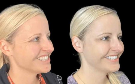 How Botox Treatment in Dubai Can Help You Look Refreshed