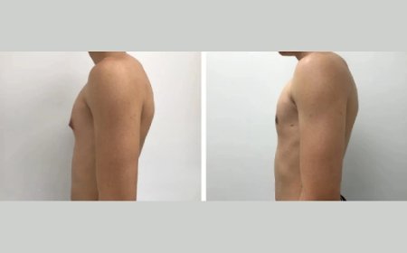 What to Wear After Gynecomastia Surgery in Dubai