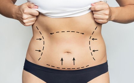 Fat Transfer in Dubai: Combining Liposuction with Body Enhancement