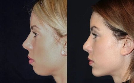Best Doctors in dubai for Chin Fillers: Everything You Need to Know About the Process