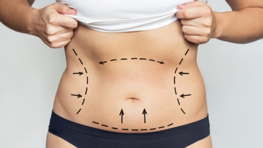 What to Expect at Every Step of Liposuction Surgery in Dubai