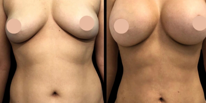Secrets Behind the Best Breast Augmentation Surgeon in Dubai