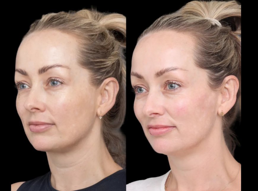 How the Best Plastic Surgeon in Dubai Offers Tailored Cheek Fillers Treatments