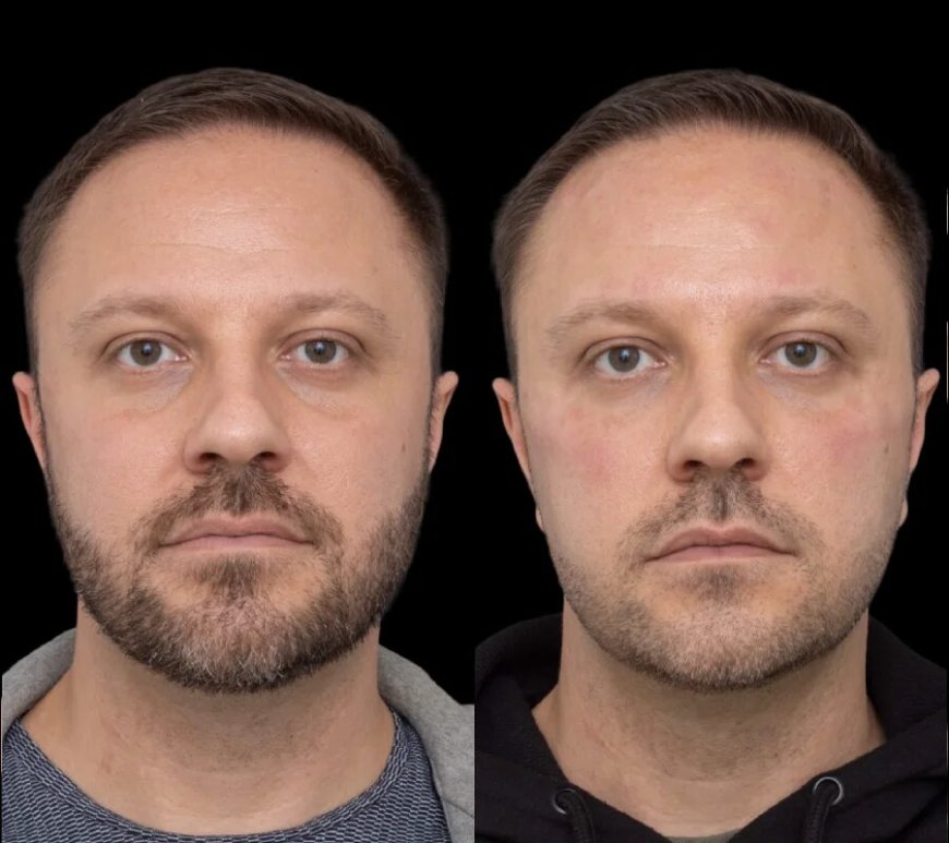 What Happens After Your Under Eye Fillers Treatment at the Best Plastic Surgeon in Dubai