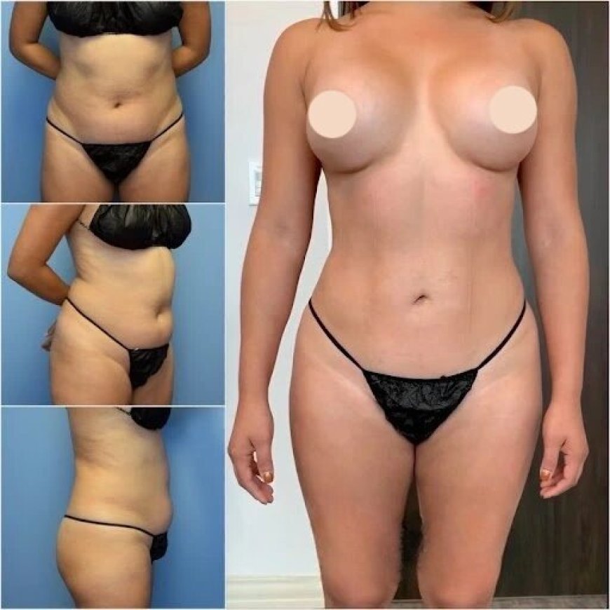 Get Beautifully Sculpted Results with the Best Body Contouring Surgeon in Dubai