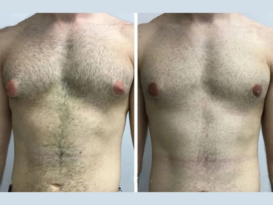 Virtual Consultation Options with the Best Gynecomastia Surgeon in Dubai