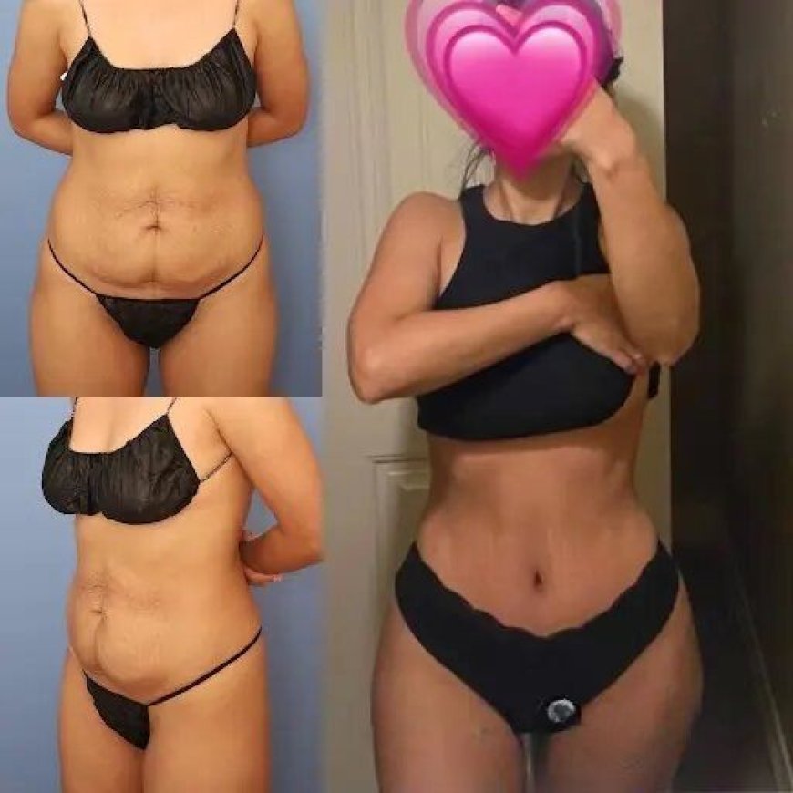 The Best Tummy Tuck Surgeon in Dubai: Helping You Achieve Your Goals