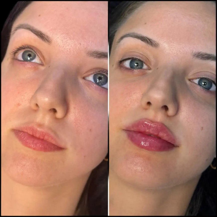 What Makes Fillers Safe with the Best Plastic Surgeon in Dubai?