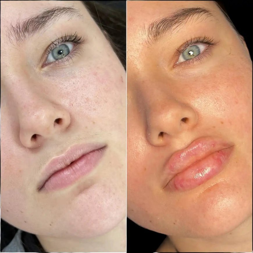Where to Find the Best Plastic Surgeon in Dubai for Dermal Fillers