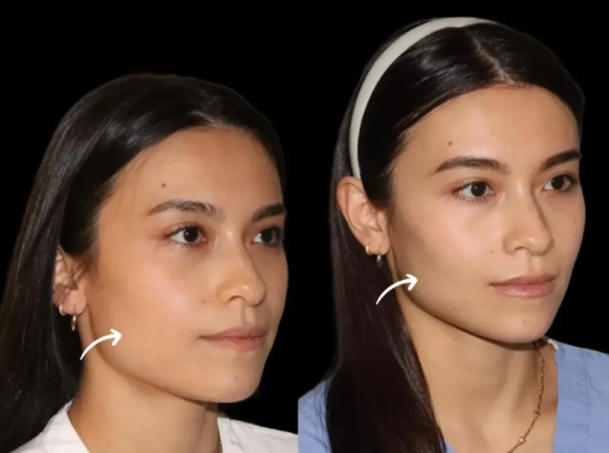 What to Expect from Your First Sculptra Fillers Treatment in Dubai