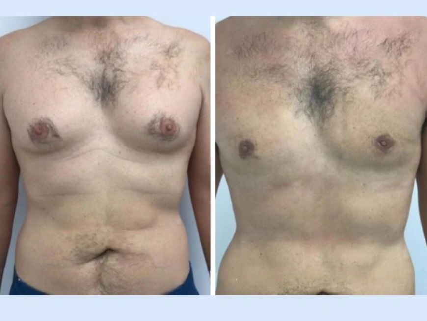 Your Ultimate Guide to Choosing the Best Gynecomastia Surgeons in Dubai