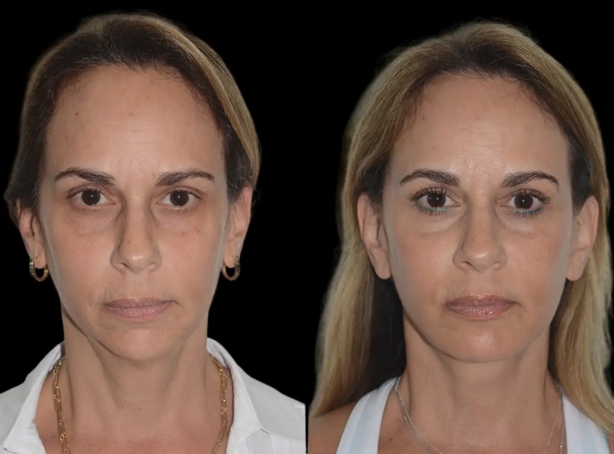 Top Benefits of Chin Fillers Treatment in Dubai for Facial Balance