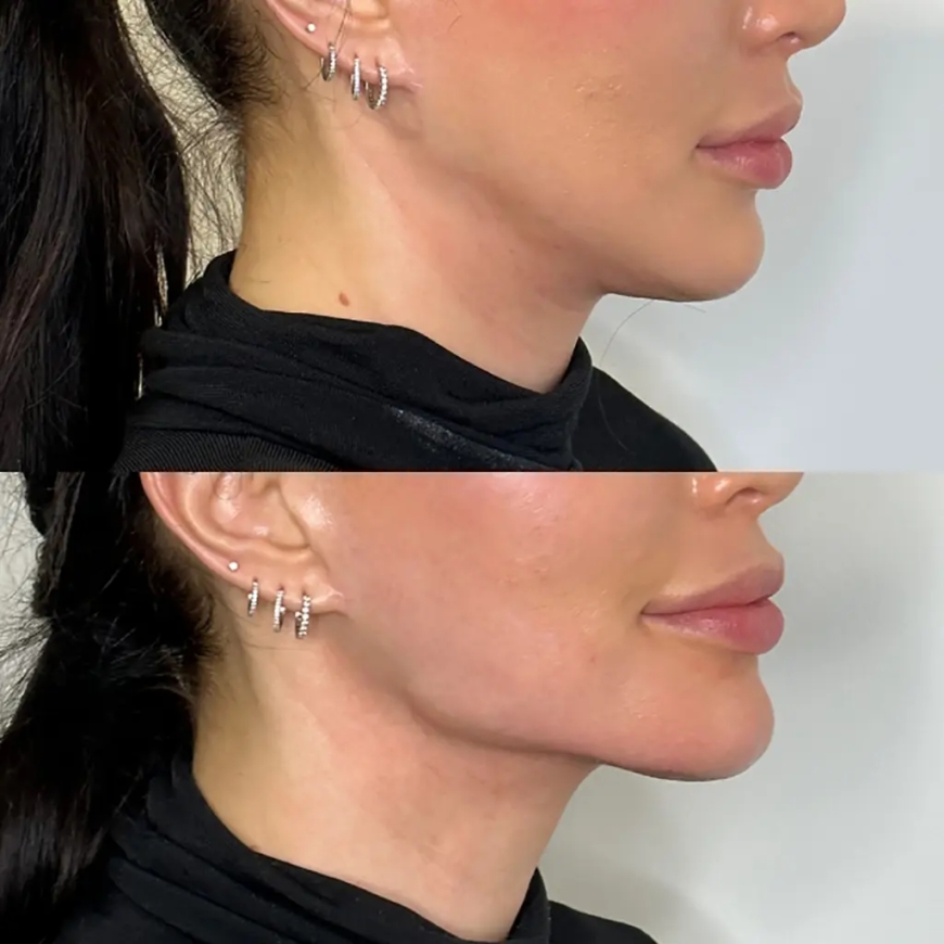 Jawline Fillers Treatment in Dubai: Sculpt Your Ideal Look