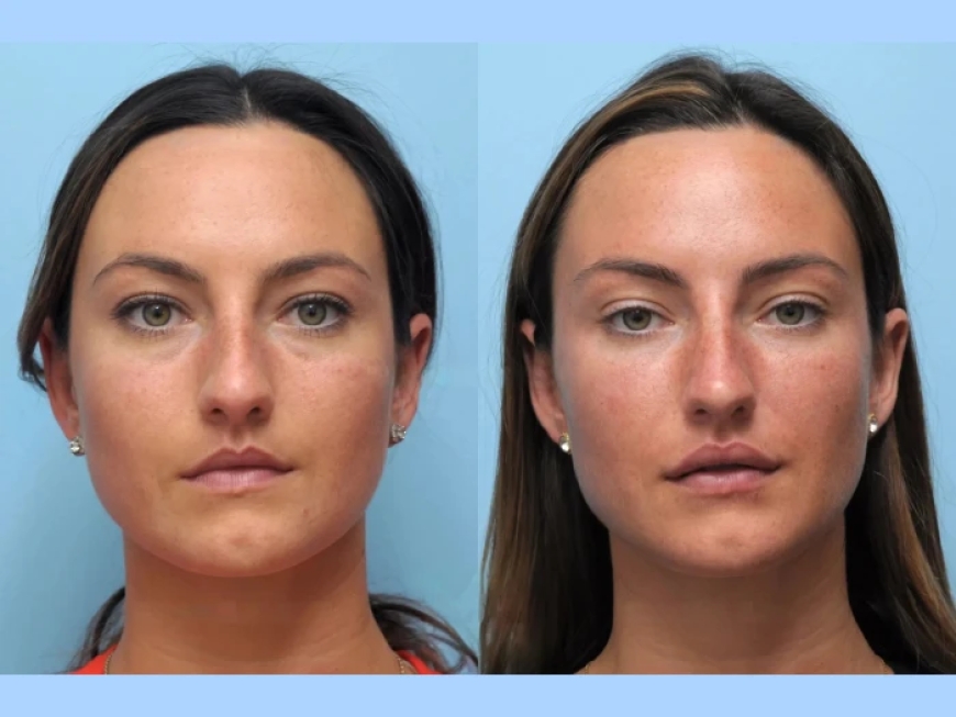 Exploring Thread Lift Treatment in Dubai for Facial Rejuvenation