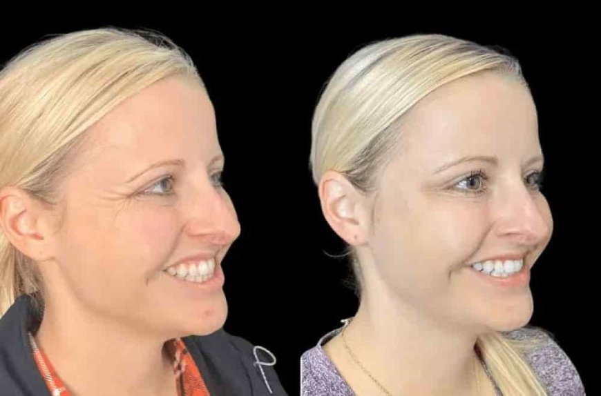How Botox Treatment in Dubai Can Help You Look Refreshed