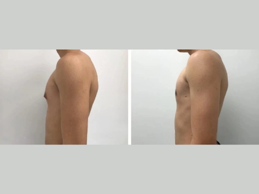 What to Wear After Gynecomastia Surgery in Dubai