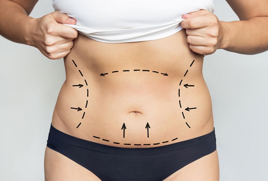 Fat Transfer in Dubai: Combining Liposuction with Body Enhancement