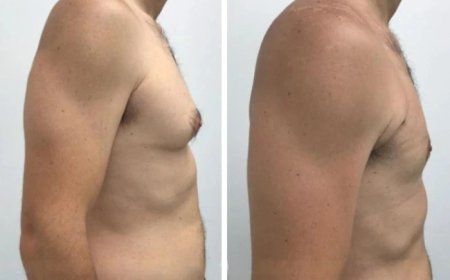 How to Find the Best Gynecomastia Surgeons in dubai for Your Treatment