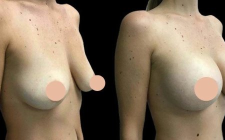 Combining Procedures with Breast Augmentation in Dubai for Total Body Makeover