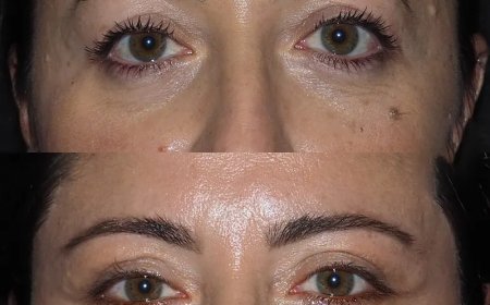 Can Eye bag removal in Dubai fix puffy under-eyes?