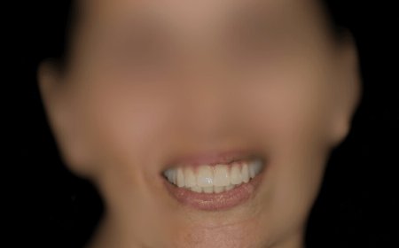 Implante Dental en Hospitalet de Llobregat Recupera tu Sonrisa
