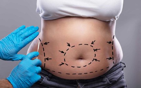 When Is the Best Time to Get a Tummy Tuck Dubai