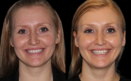 What is Eyelid Bag Surgery in Dubai and How Does it Work?