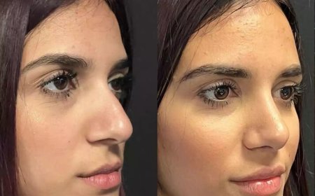 Looking for Results? Best Septoplasty Surgeons in Dubai Deliver