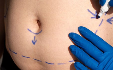 How Abdominoplasty in Dubai Can Transform Your Body and Boost Confidence