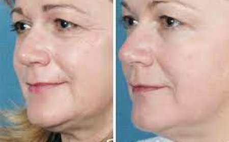The Gentle Lift: How Laser Skin Tightening Rewinds Time Without Surgery