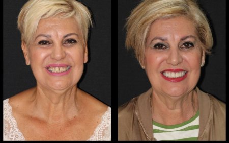 Implante Dental en Hospitalet de Llobregat Recupera tu Sonrisa