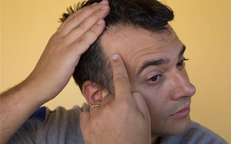 Can Hairline Be Regrown Through FUE Hair Transplant