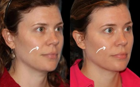The Psychology of Sculptra Fillers: Best Plastic Surgeons in Dubai Insights