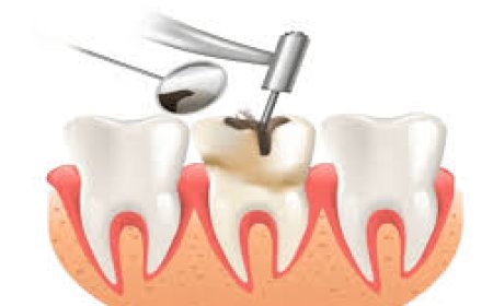Root Canal Treatment Cost: Your Complete Guide to Affordable Dental Care