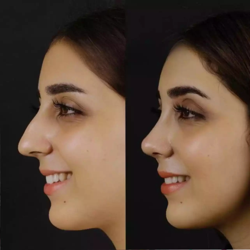 Septoplasty in Dubai: From Diagnosis to Recovery