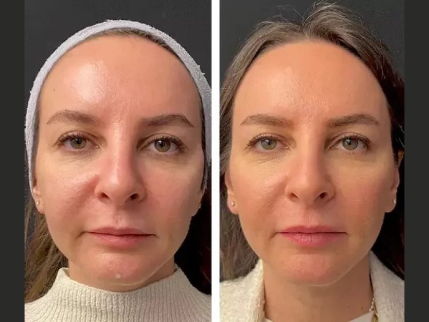 Benefits of Choosing the Best Aesthetic Clinic in Dubai for Mesotherapy