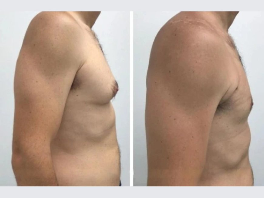 How to Find the Best Gynecomastia Surgeons in dubai for Your Treatment