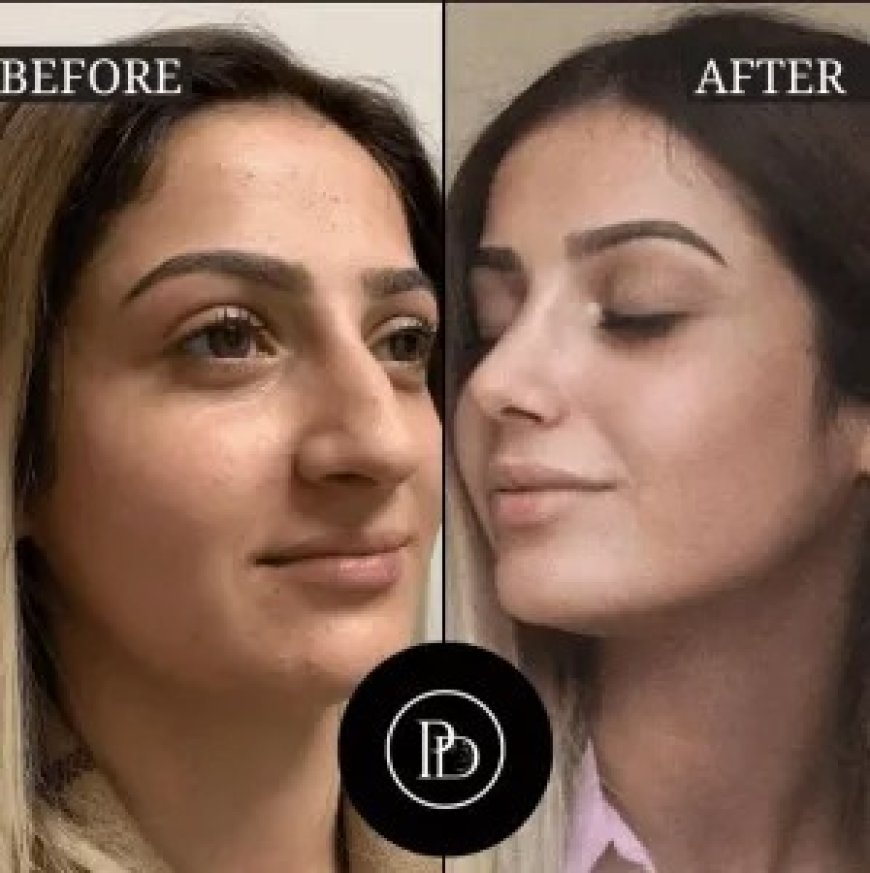 Reverse Hair Loss with PRP Treatment in Dubai