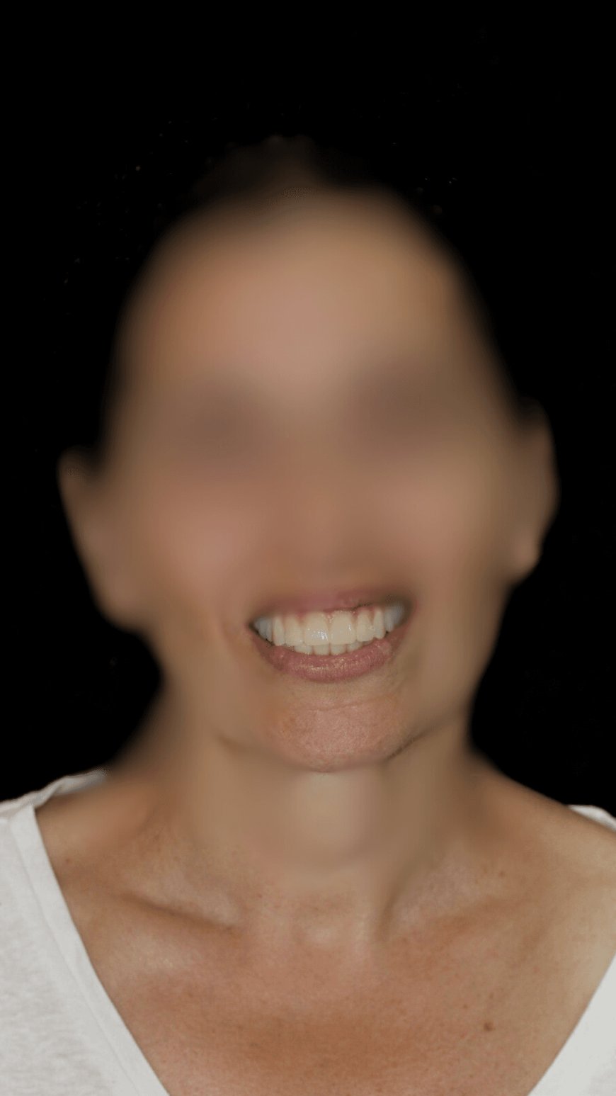 Implante Dental en Hospitalet de Llobregat Recupera tu Sonrisa
