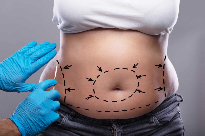 When Is the Best Time to Get a Tummy Tuck Dubai