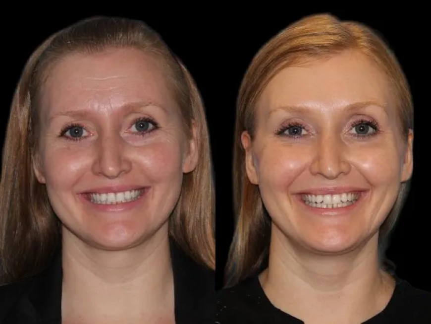 What is Eyelid Bag Surgery in Dubai and How Does it Work?