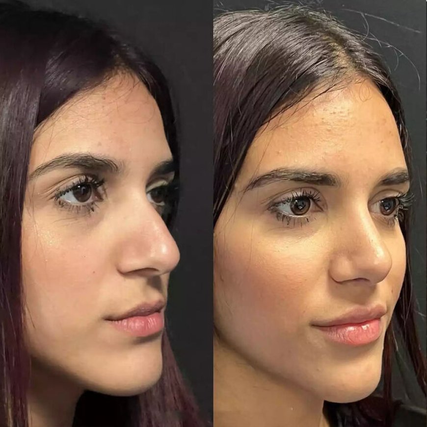 Looking for Results? Best Septoplasty Surgeons in Dubai Deliver