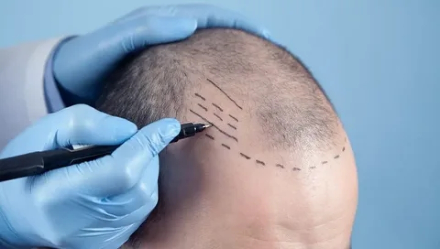 Crowning Glory Restored: Effective Female Hair Loss Treatment in Faisalabad